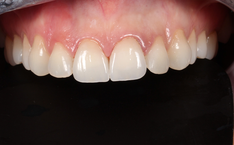 Aventis Dental & Facial Aesthetics - Case 2 2024 A After - Aventis dental