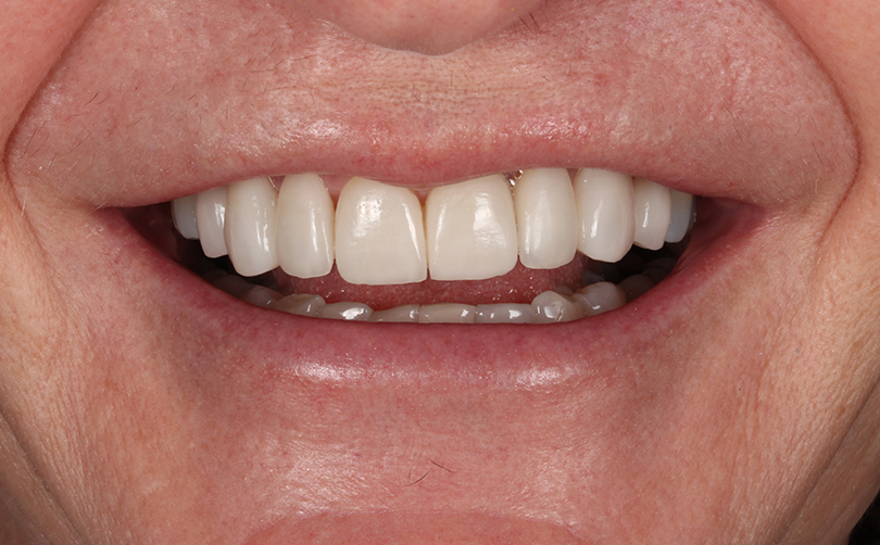 Aventis Dental & Facial Aesthetics - Case 4 2024 A After - Aventis dental