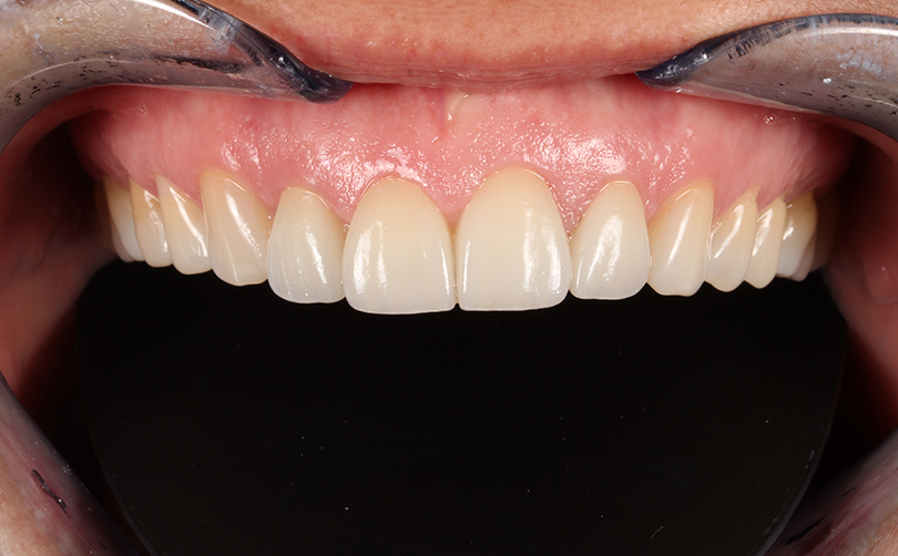 Aventis Dental & Facial Aesthetics - Case 5 2024 A (2) After - Aventis dental