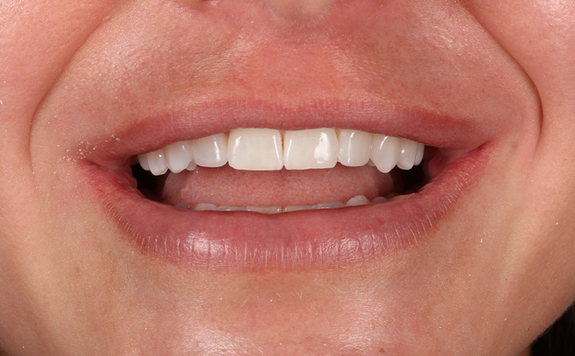 Aventis Dental & Facial Aesthetics - Case 6 2024 A After - Aventis dental