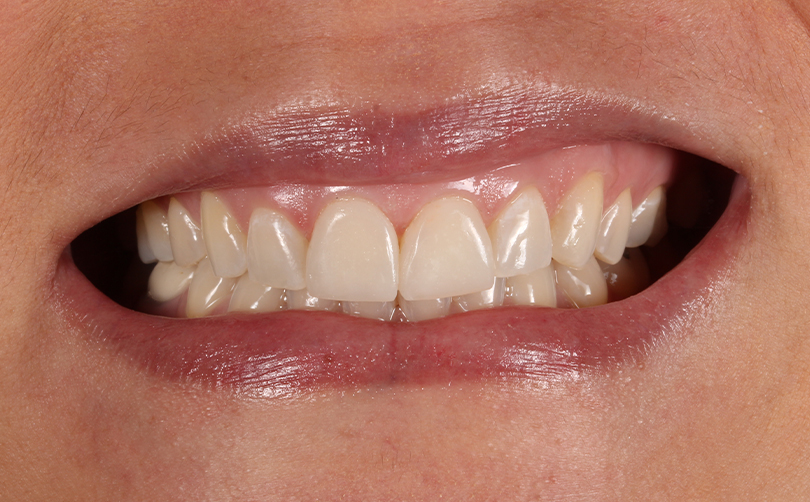 Aventis Dental & Facial Aesthetics - Case 9 2024 A After - Aventis dental