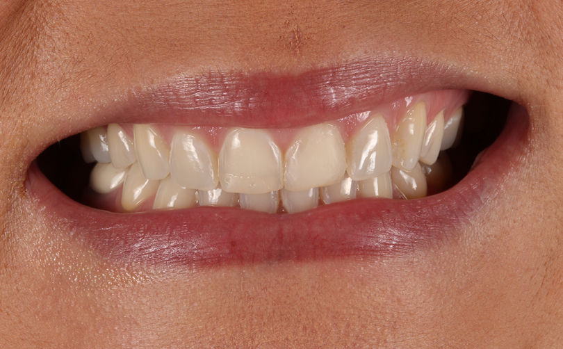 Aventis Dental & Facial Aesthetics - Case 9 2024 B Before - Aventis dental