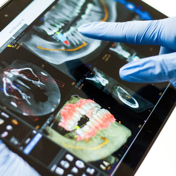 Dental implant evaluation