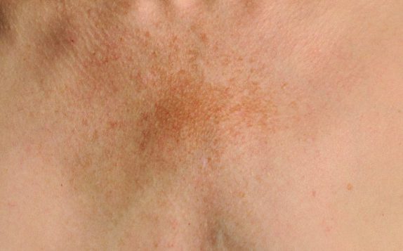 sun damage on skin