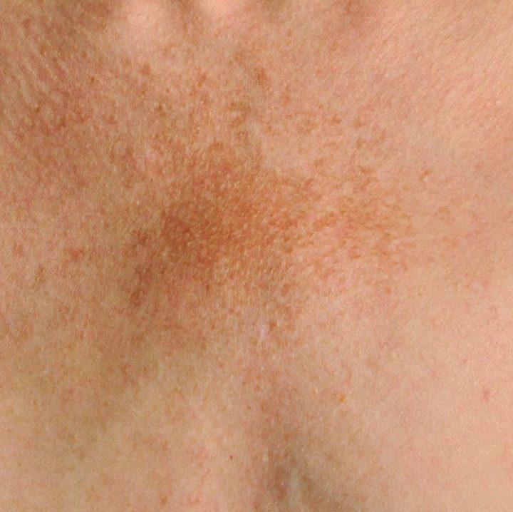 Treatment - Aventis Dental