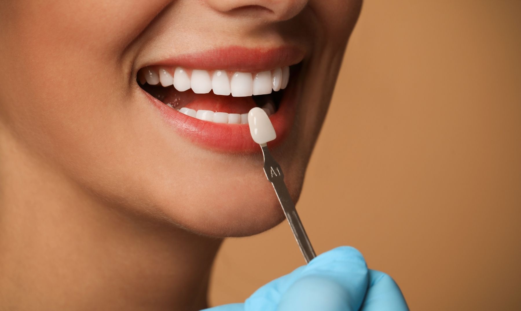 what veneers look like