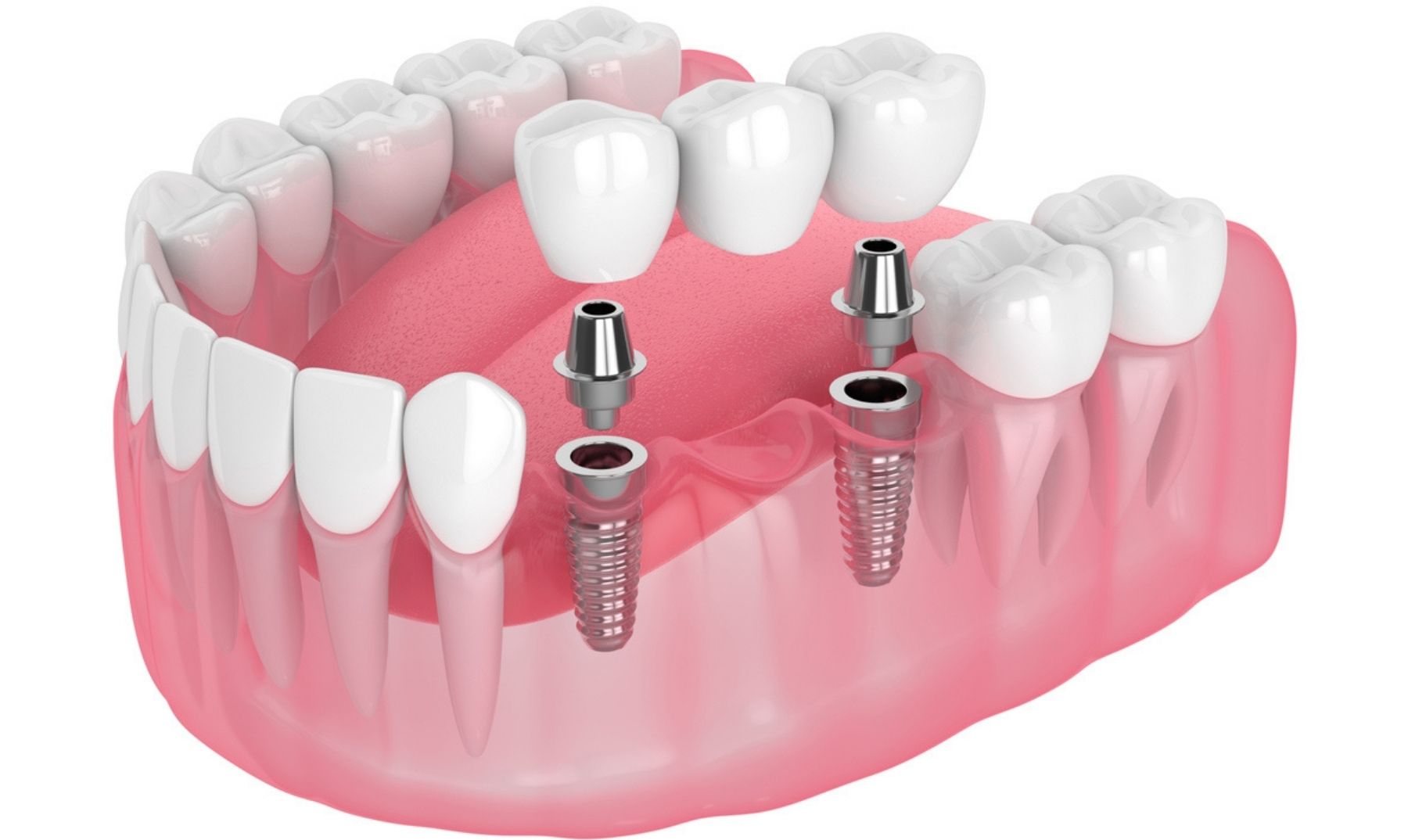 implant bridge