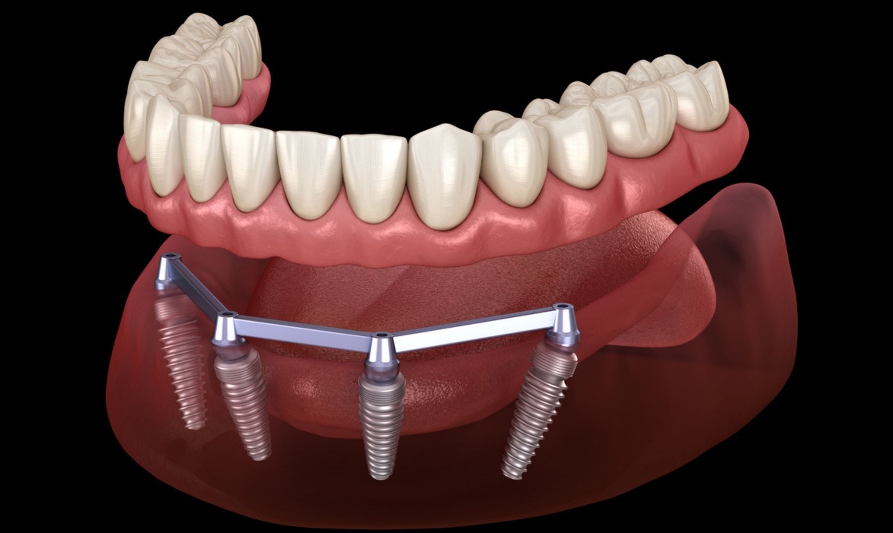 implant denture
