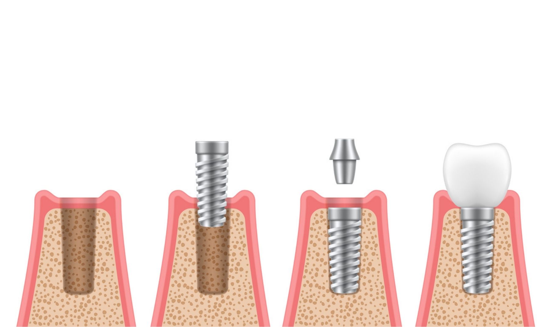 implant procedure