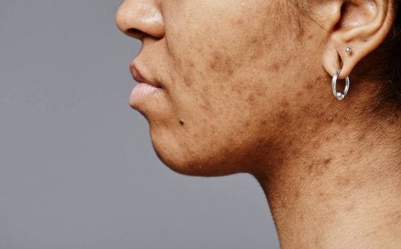 pigmentation