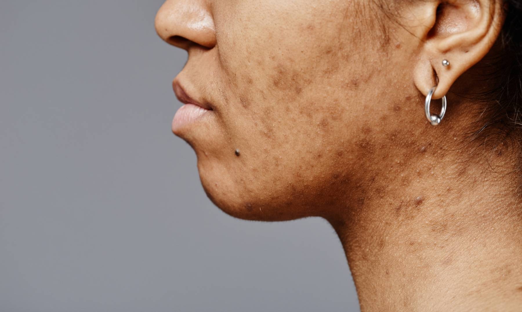 pigmentation