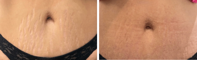 before and after halo