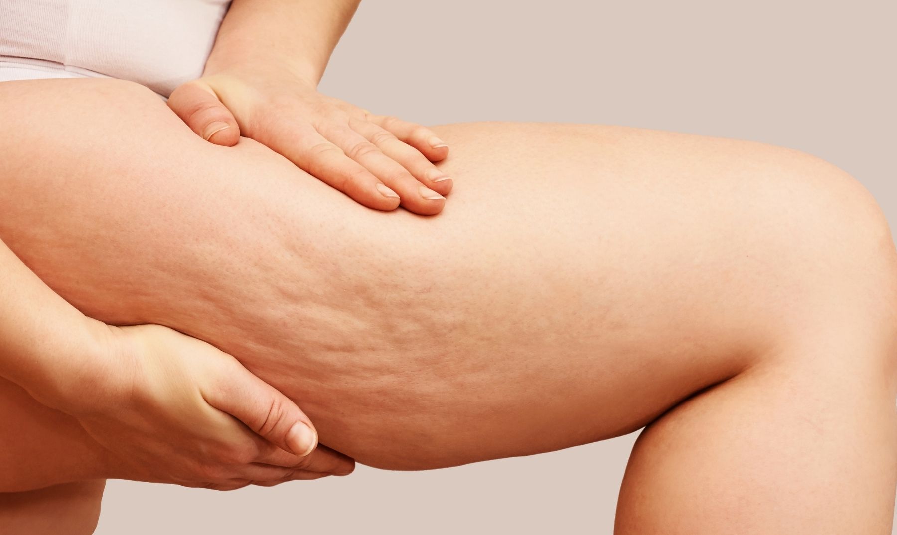 cellulite