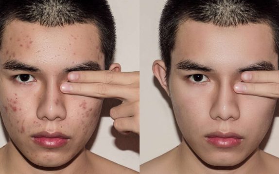 clear skin