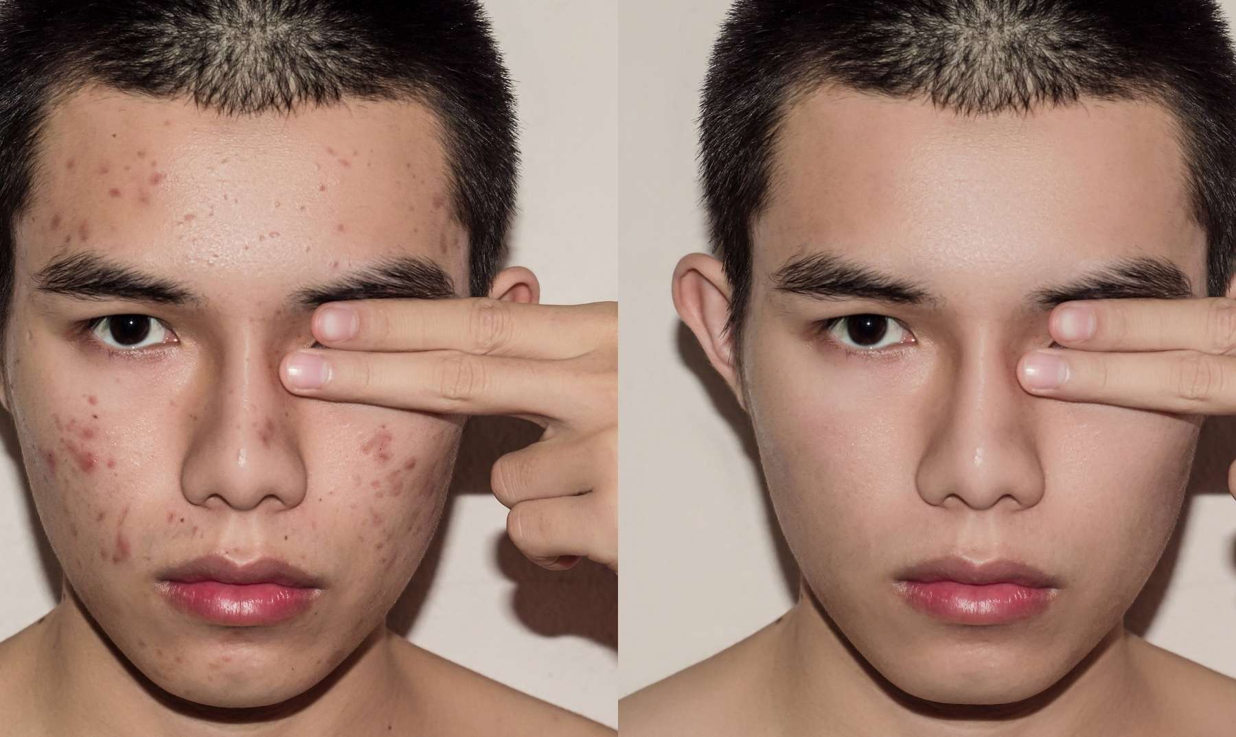 clear skin