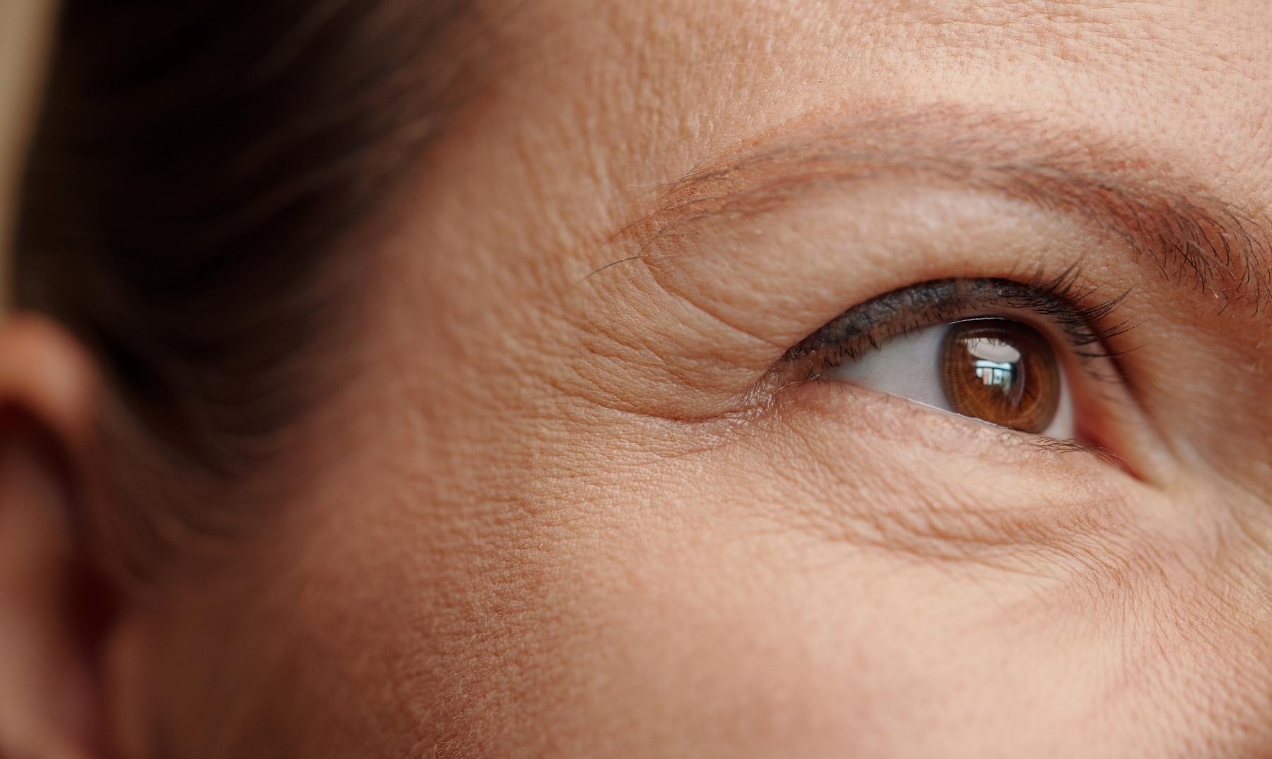 crows feet