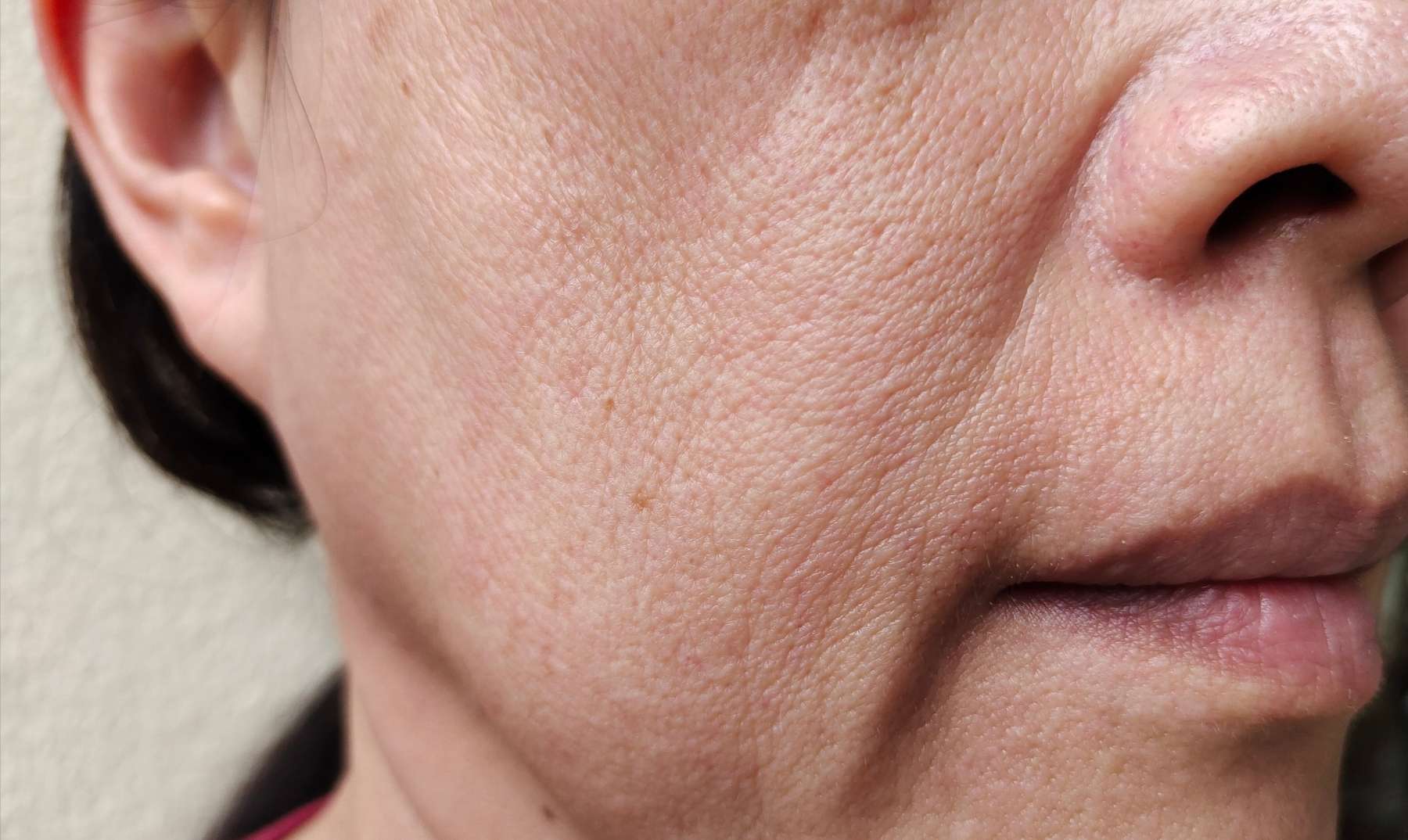 drooping skin