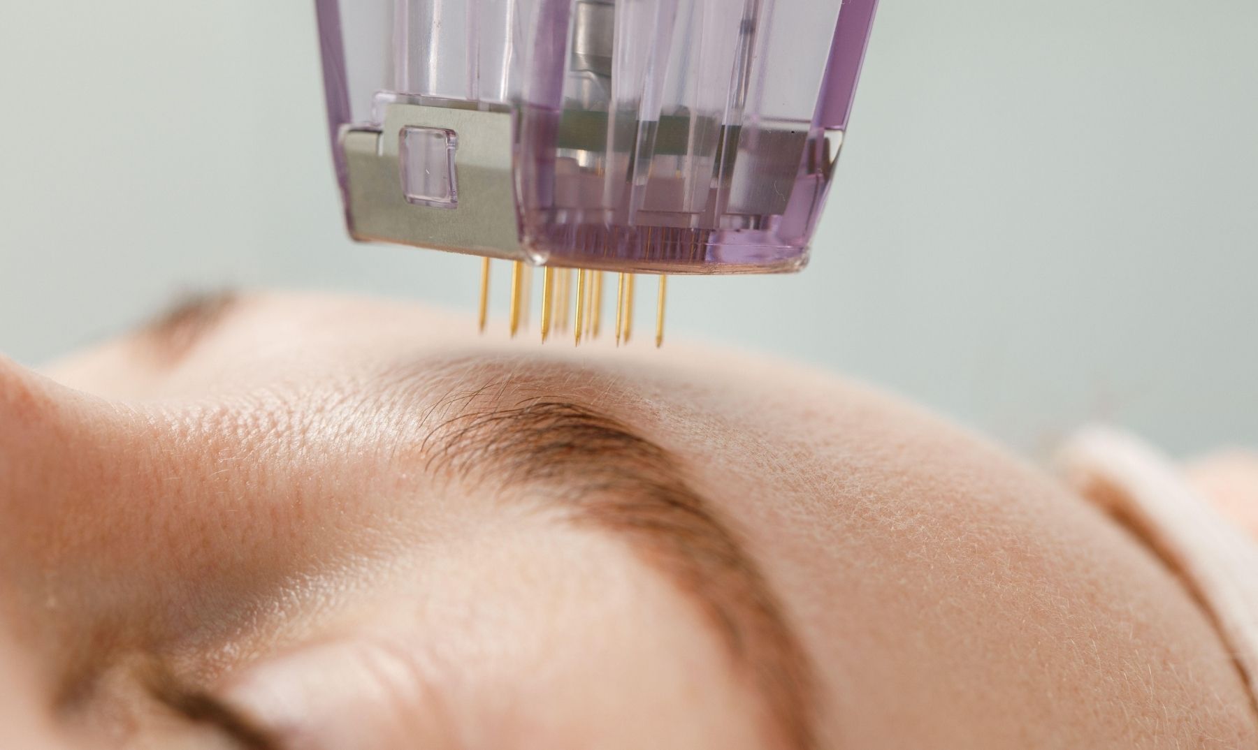 microneedling