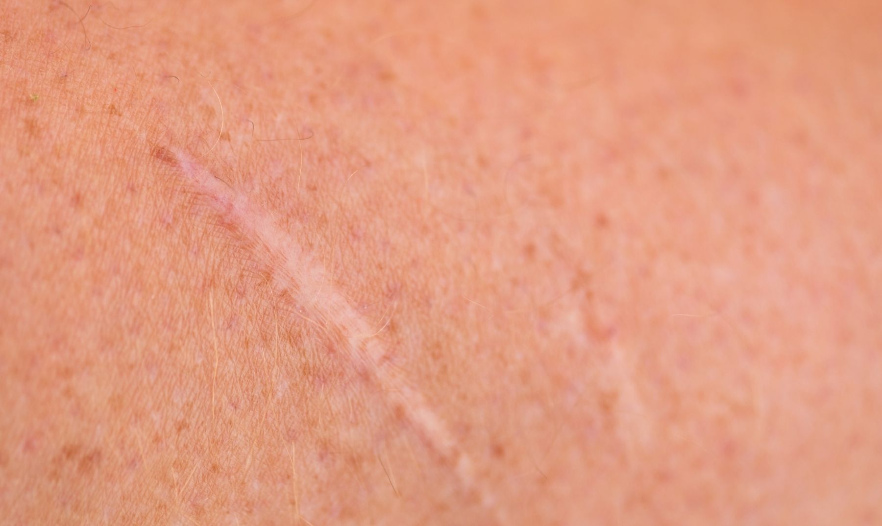 scars