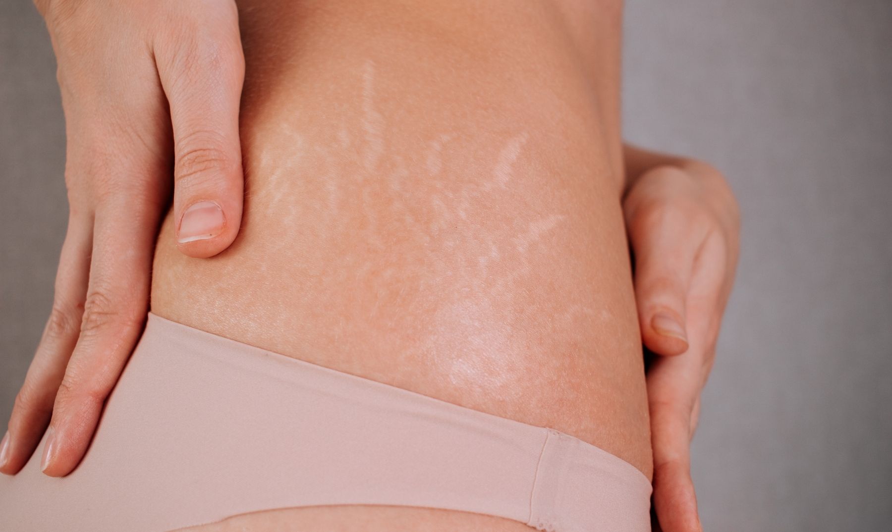 stretch marks