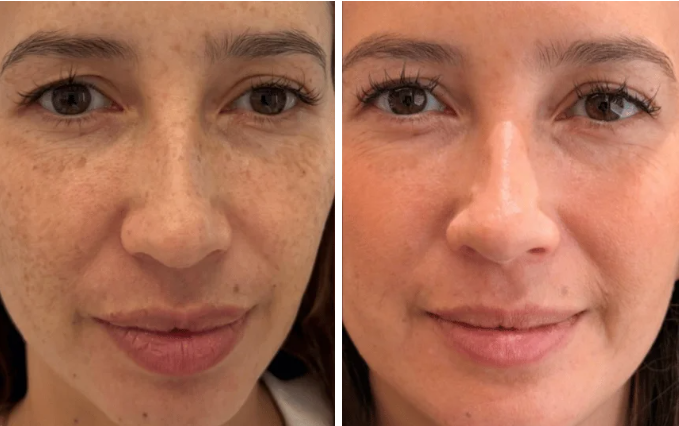 bbl and moxi before and after