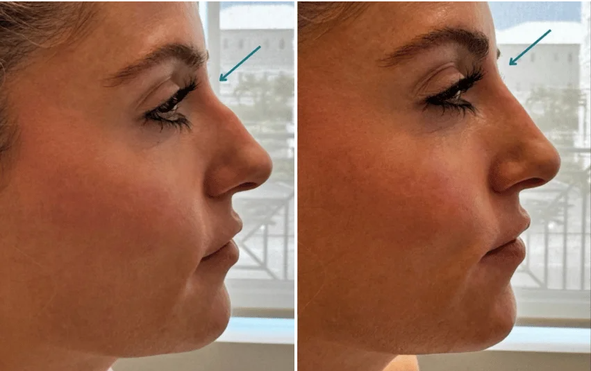 before and after nose reshaping