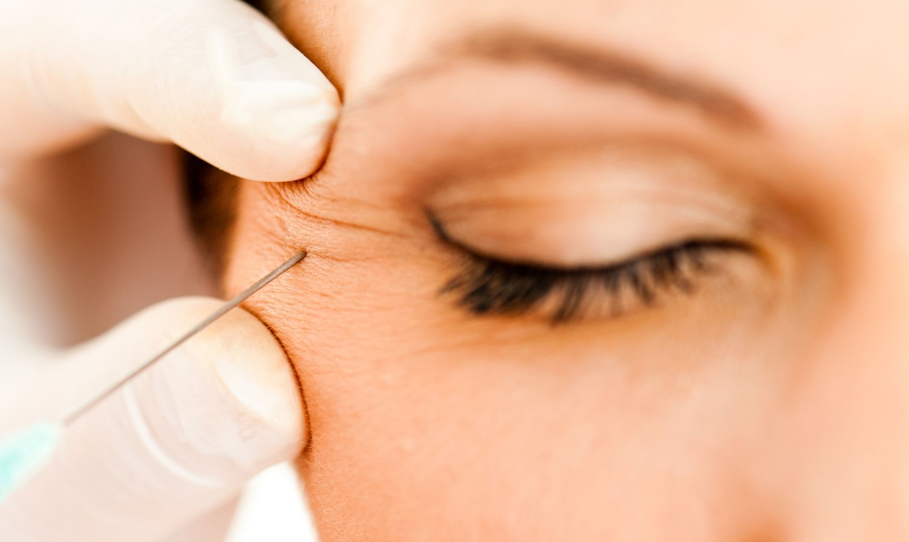 crows feet