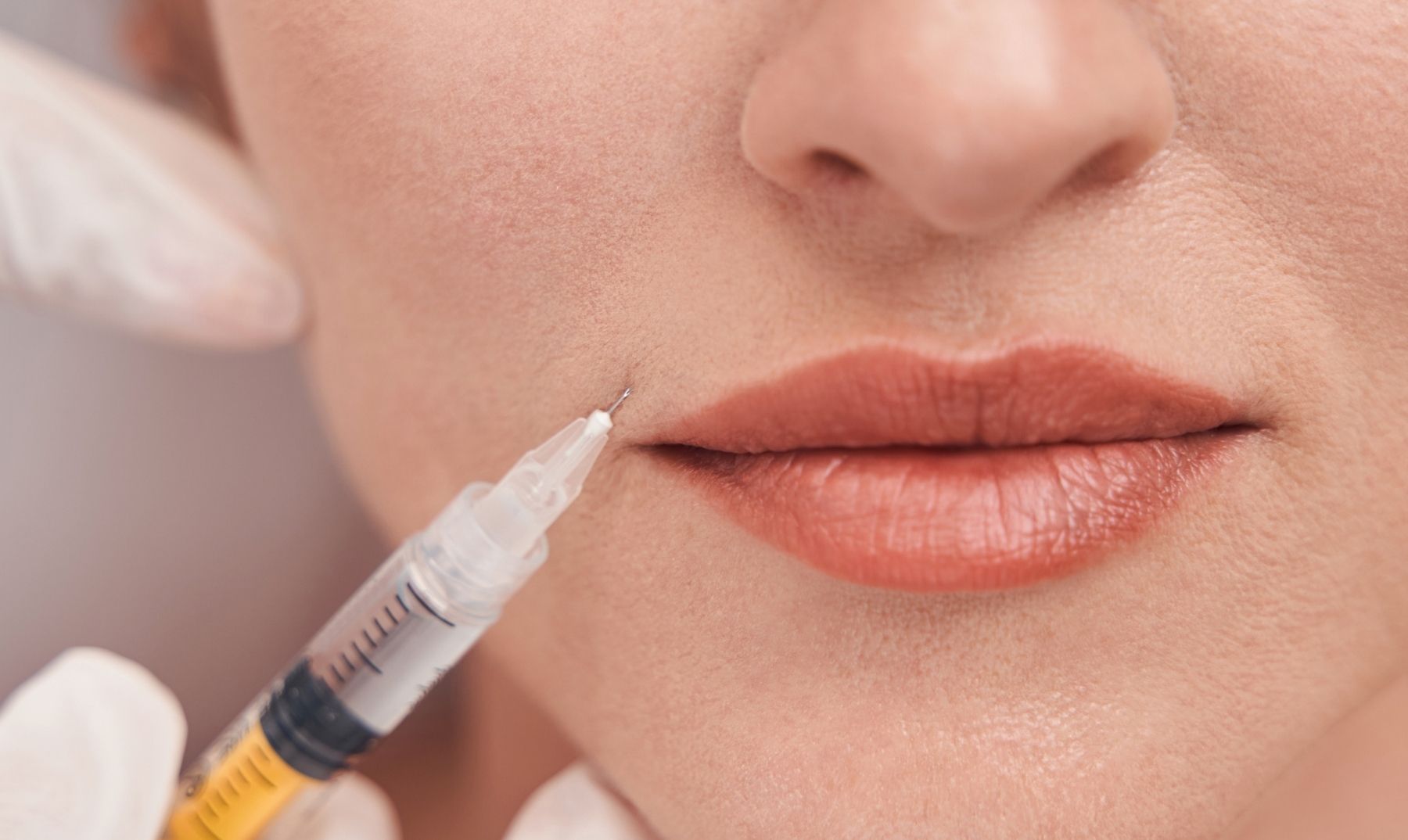Nasolabial Fold Filler